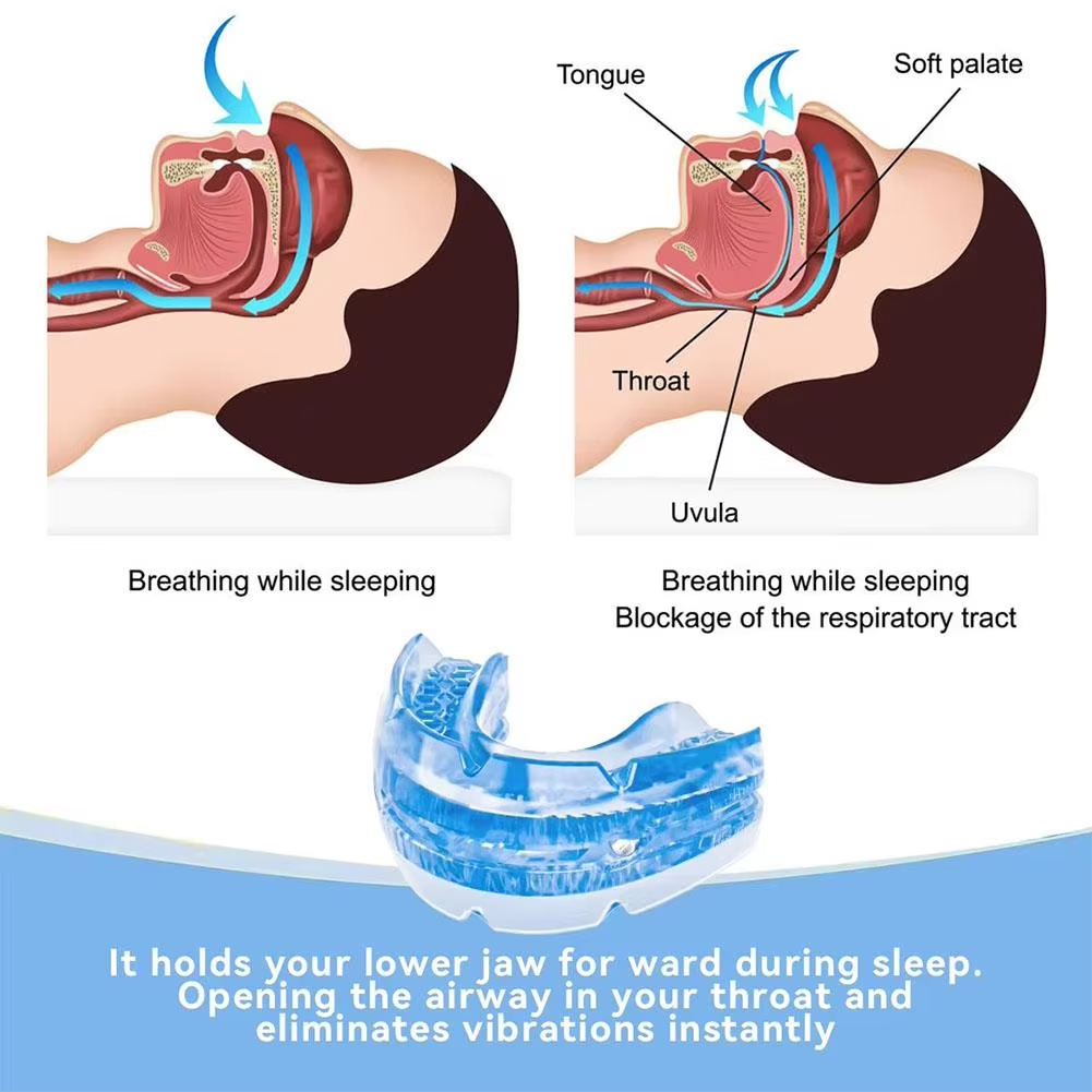Adjustable Mandibular Advancement Device for Snoring Reduction