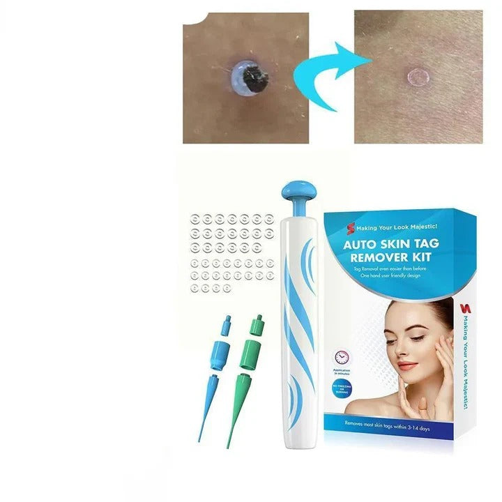 Loop-Based Application Tool for Manual Skin Tag Removal